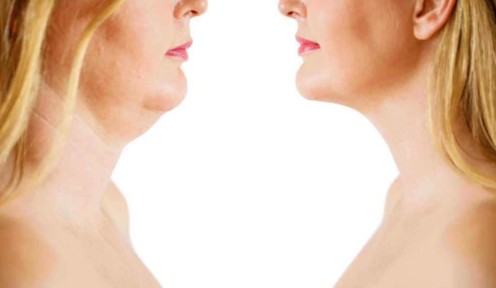 Double Chin treatment Worcestershire before and after results