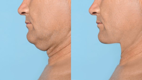 Which Non-Surgical Treatments Work Best for Jowls and Loose Skin Worcestershire?