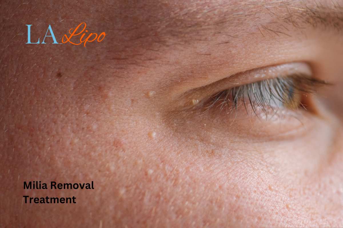 Cryopen Milia Removal: Is It the Easiest and Safest Option Worcestershire?