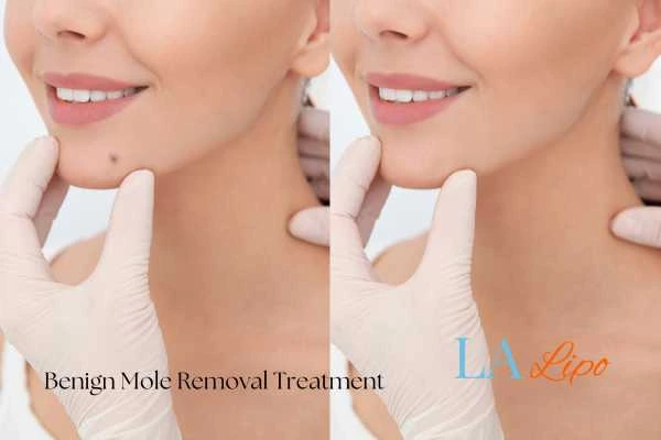 Before-and-after results following benign mole-removal treatment Worcestershire