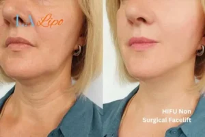 hi-fu for wrinkles Worcestershire before and after results