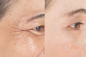 Before and after results of woman - HI-fu wrinkles reduction treatment Worcestershire