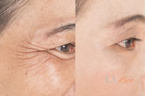 Before and after results of woman - HI-fu wrinkles reduction treatment Worcestershire
