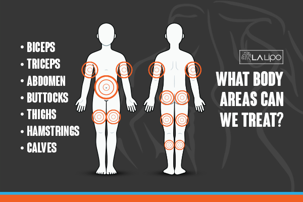 Graphic to show areas you can have LA-EMS Body Sculpting Worcestershire treatment.