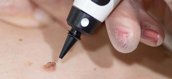 skin tag removal using cryopen Worcestershire