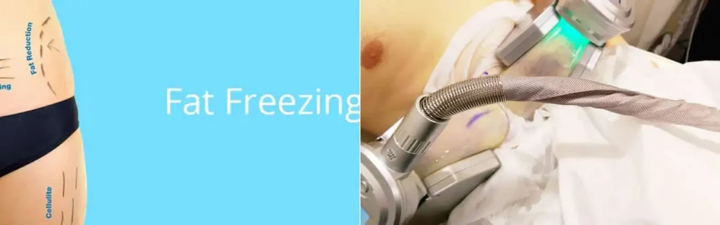 Fat freezing Worcestershire on multiple areas of the body