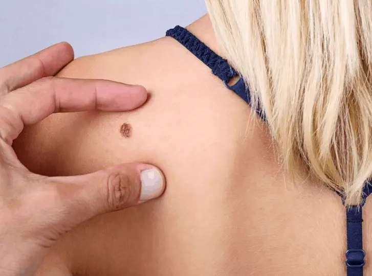woman having mole removal Worcestershire consultation before treatment.