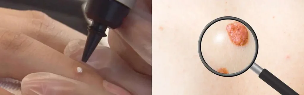 Cryopen for mole removal Worcestershire - speak to our team today!