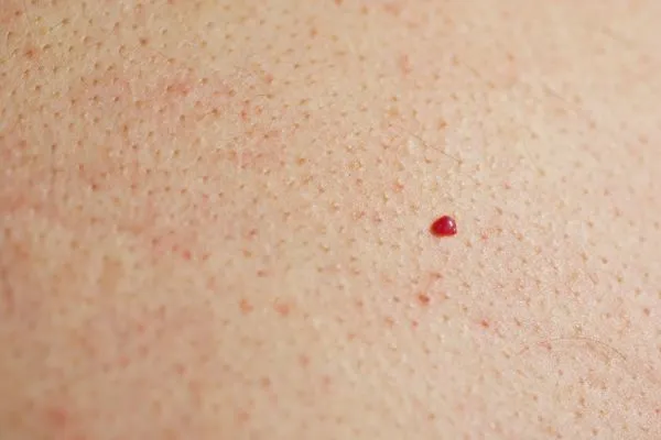 close up of a cherry angioma Worcestershire