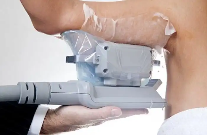 Picture of fat freezing Worcestershire on the upper arms.