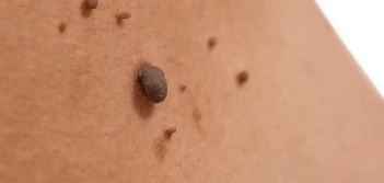 image of a skin tag Worcestershire