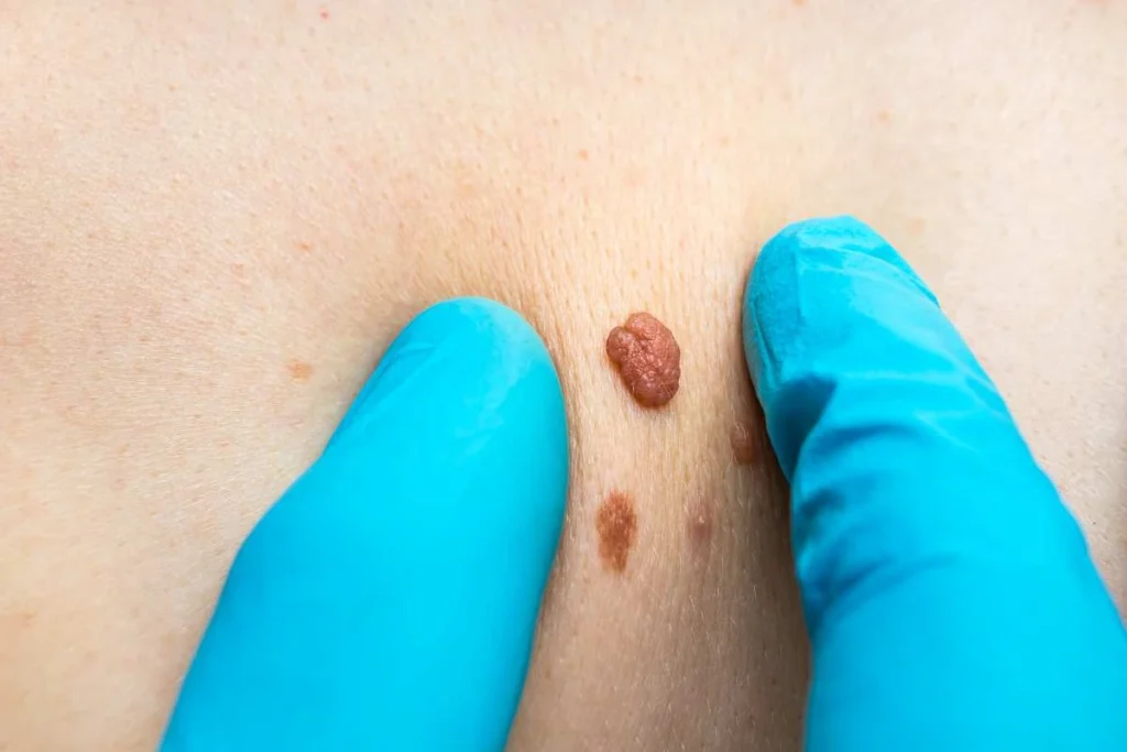 Consultant examining a skin tag Worcestershire