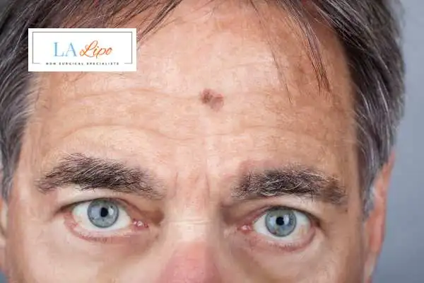 Solar Lentigo Removal Worcestershire image of man with mark on his forehead