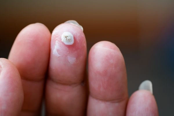 wart on person finger - cryotherapy to treat from LA LIPO Worcestershire