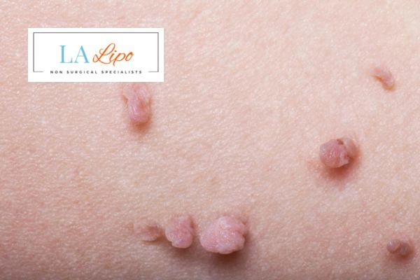 Does cryopen skin tag removal Worcestershire hurt? Find out now call our team today!