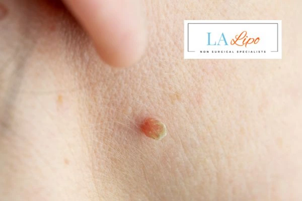 Book skin tag removal Worcestershire today speak to our team now!