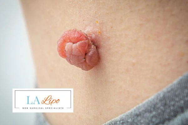 Interested in skin tag removal Worcestershire? Concerned about the pain? Find out more today!