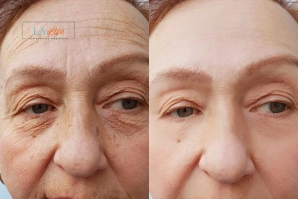 The powerful benefits of Morpheus8 Treatment Worcestershire - Call Our team today!
