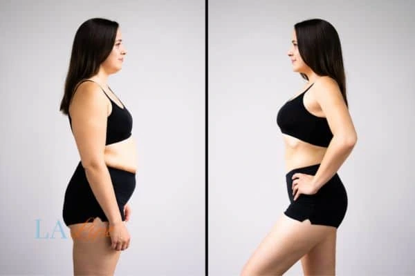 Picture of womans before and after using LA-EMS body sculpting to improve her core strength Worcestershire