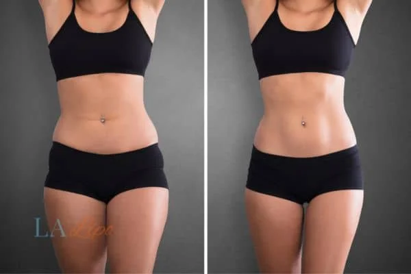 before and after results of non-surgical treatment to help a woman's body image and mental health Worcestershire