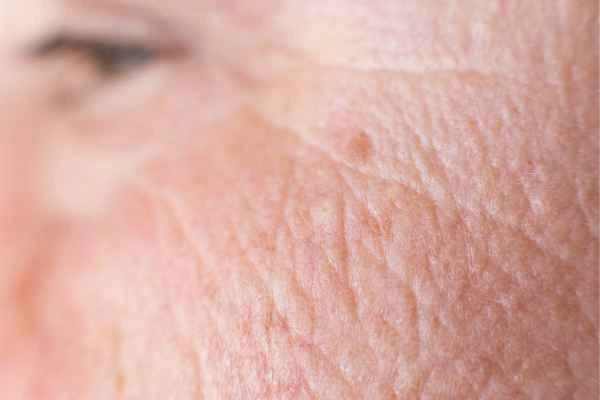 close up picture of a woman's face showing an age spot Worcestershire