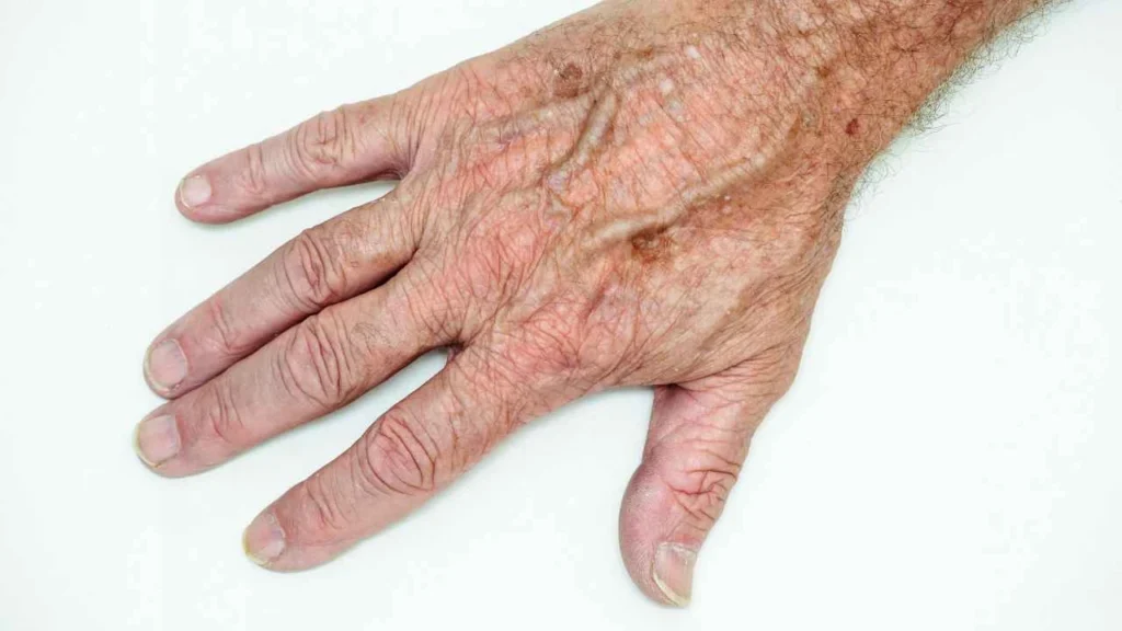 Male hand showing age spot Worcestershire
