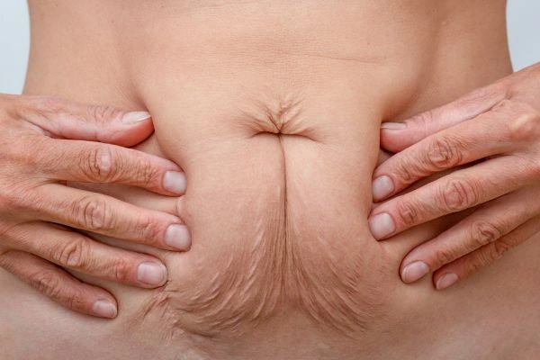 Should I Combine Diastasis Recti Treatment with Body Contouring for Better Results Worcestershire?