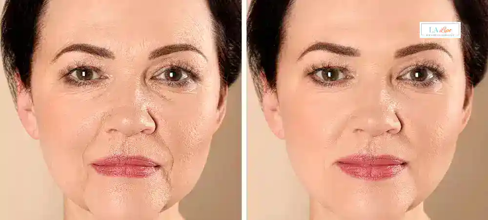 How Long Does It Take to See Results and How Long Do They Last Worcestershire?