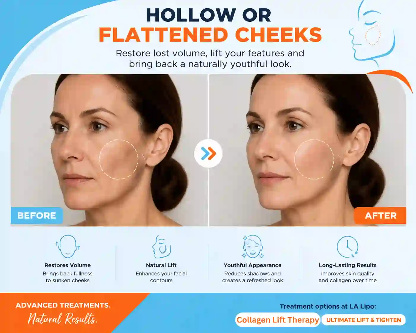 Sign #4: Hollow or Flattened Cheeks Worcestershire