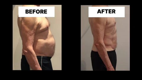 What Symptoms Can Diastasis Recti Cause in Men? Weak Core, Back Pain and Poor Posture Worcestershire